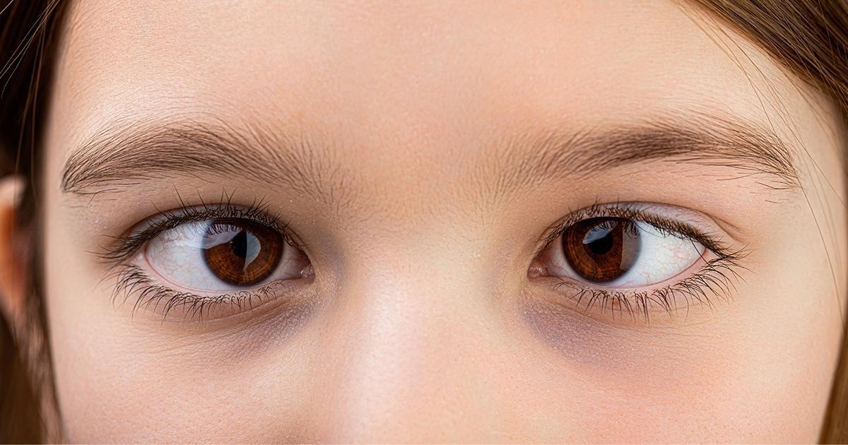 What Causes a Squint and How Does Squint Eye Treatment Fix It?
